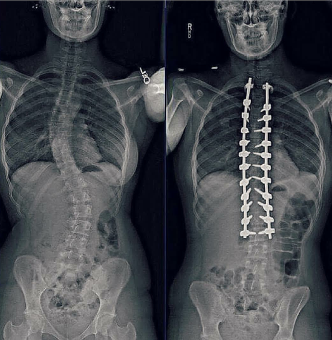 preoperative and postoperative Xray of scoliosis MEDizzy