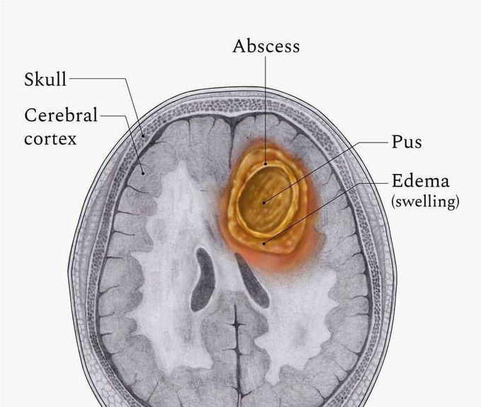 Cause of Temporal lobe abscess