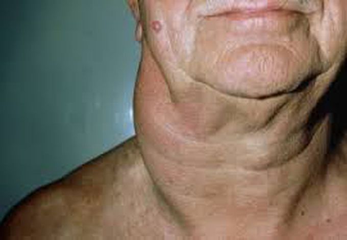 Non-infectious Etiology of Cervical Lymphadenopathy