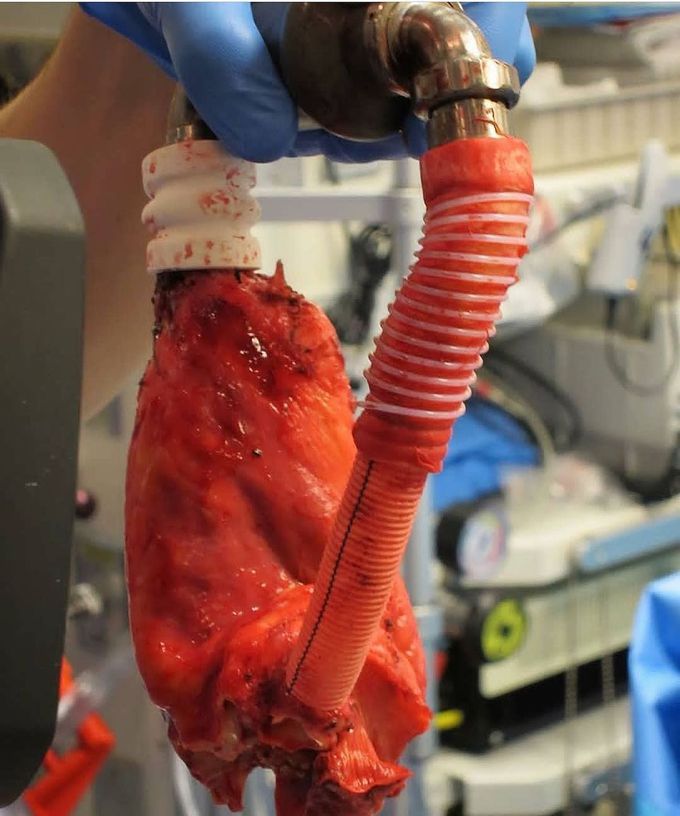  Left Ventricular Assist Device (LVAD)