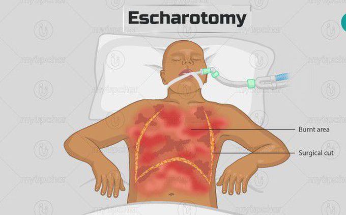 Escharotomy complication