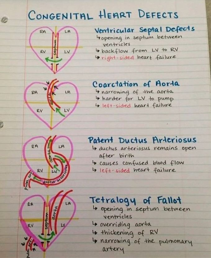 Congenital heart defects