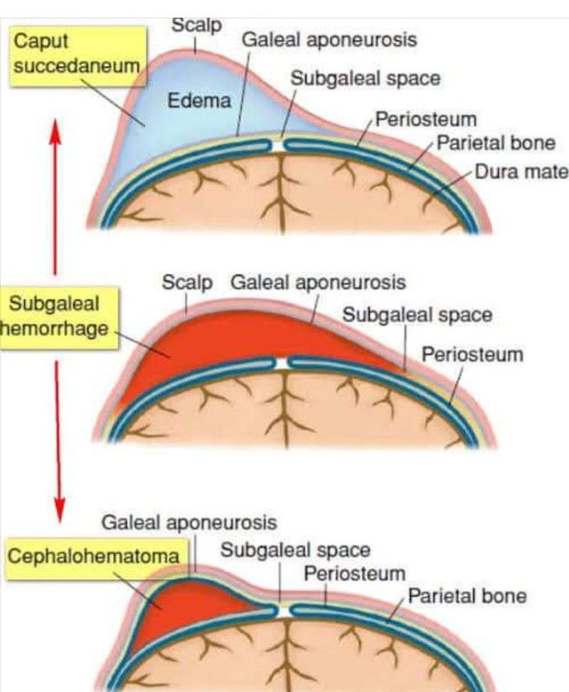 difference-between-caput-cephalhematoma-and-subgaleal-medizzy