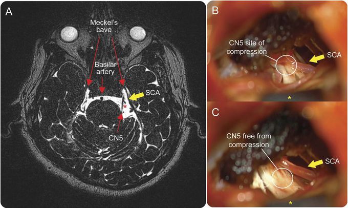 Trigeminal Nerve Compression