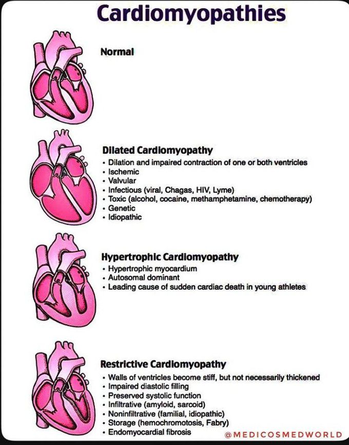 Cardiomyopathys - MEDizzy