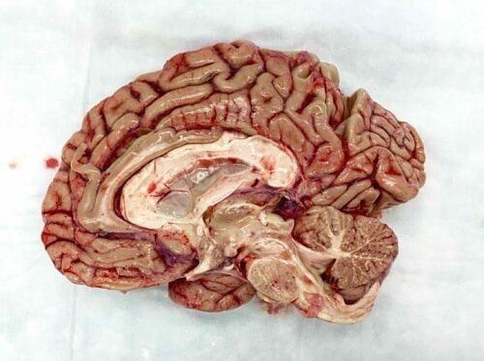 Which side of your brain do you think is dominant for speech? Ever heard of wada test? 