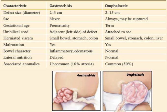 Gastroschisis vs omphalocele