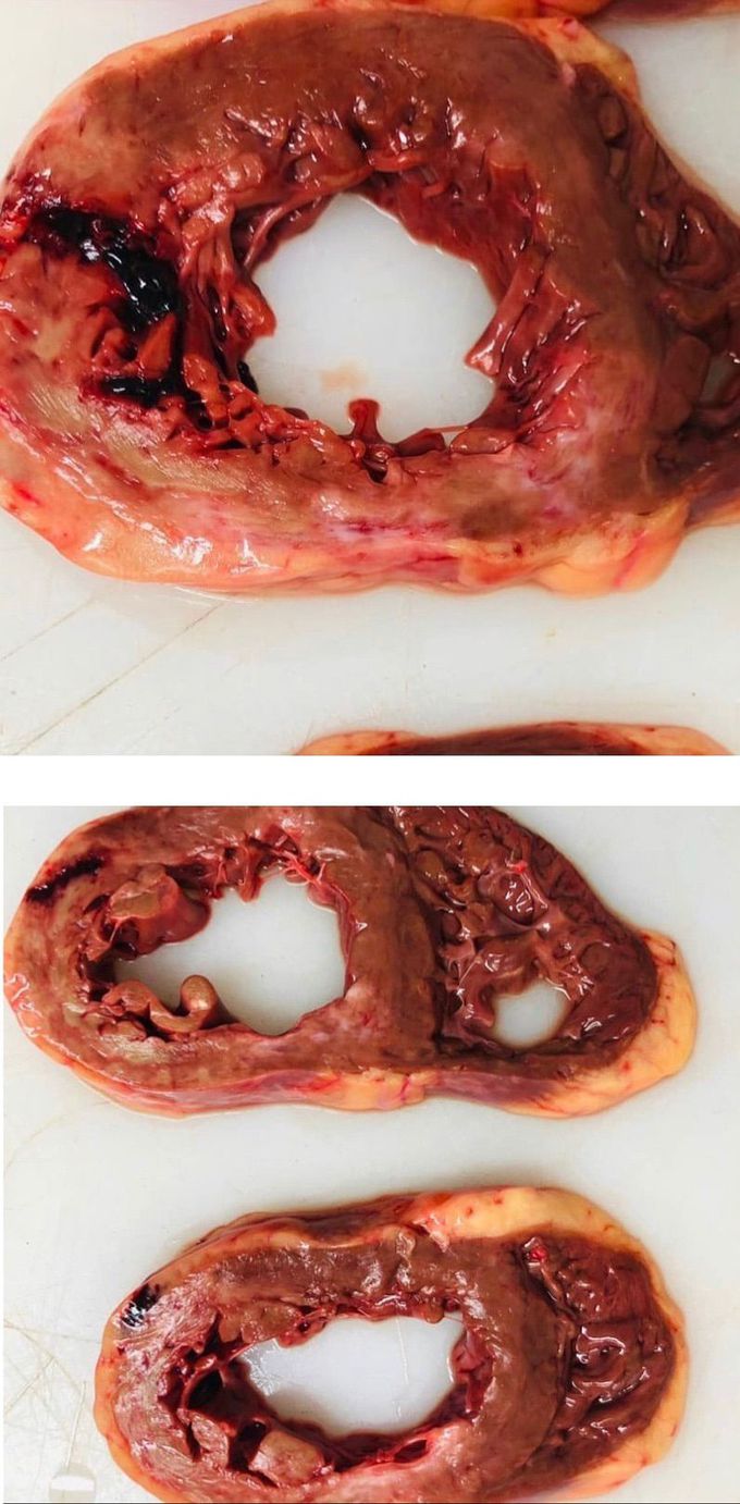 Ventricular rupture following MI