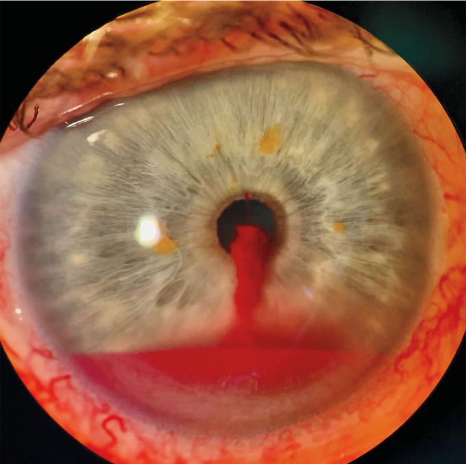 Spontaneous Hyphema