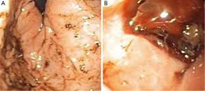 Cushings ulcer