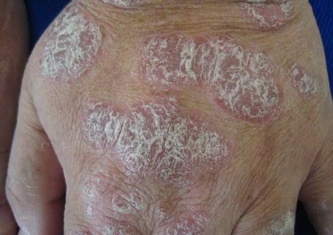 Plaque Psoriasis