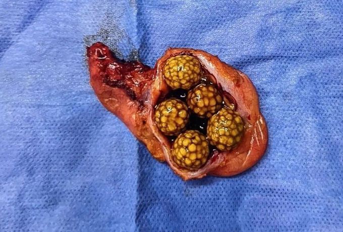 Gallstones