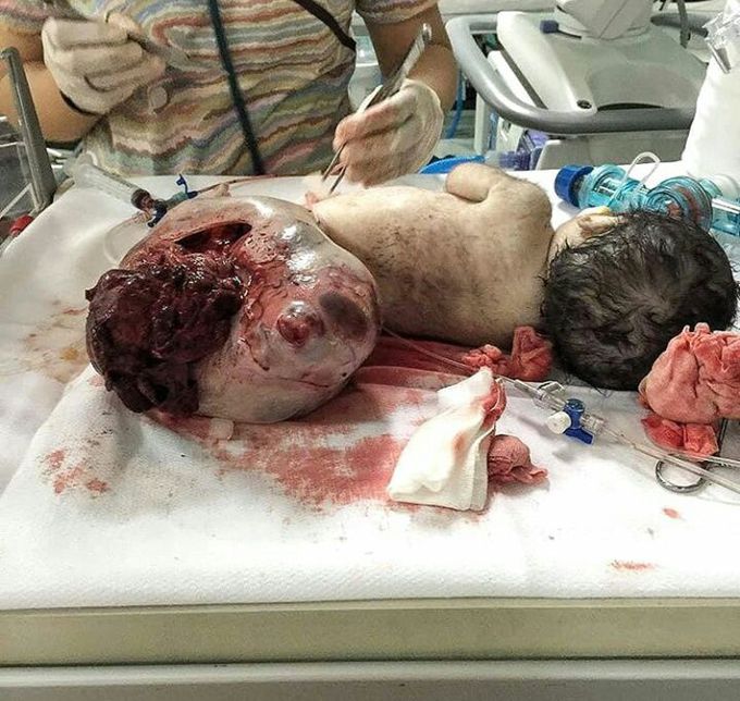 Sacrificial coccygeal teratoma
