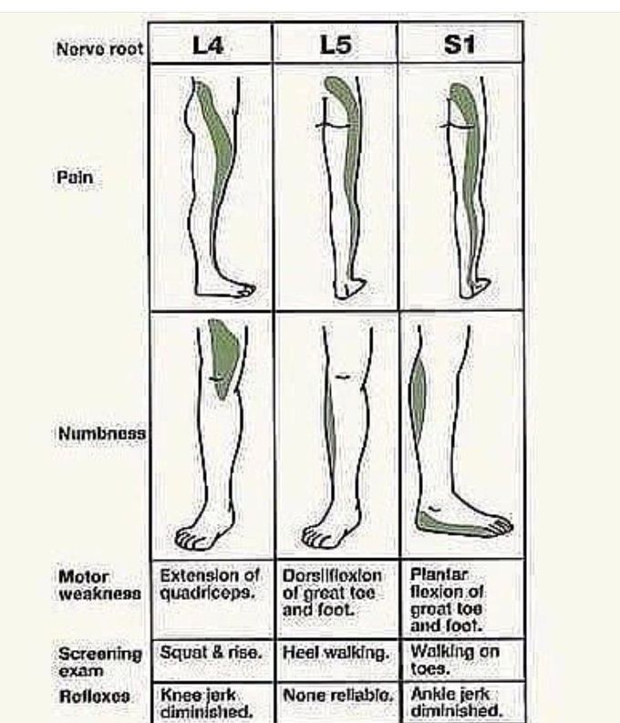 Lumber Nerve Roots