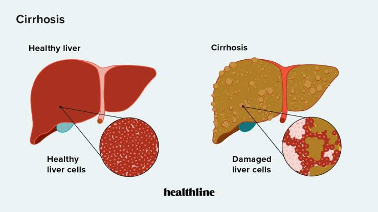 Signs Of Decompensated Cirrhosis MEDizzy