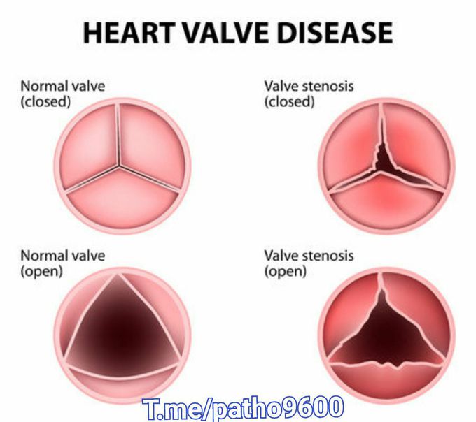 Pathology of the Heart