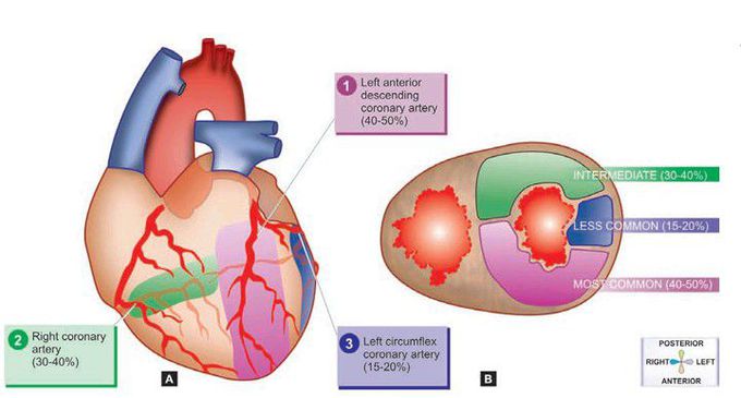 Myocardial infarction