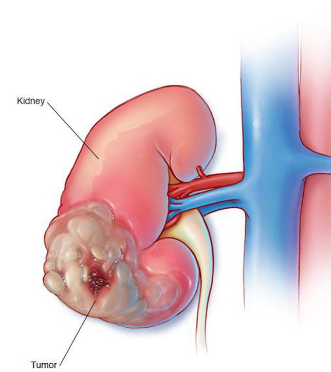 Kidney cancer