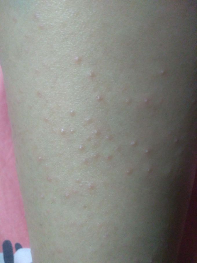 Patient presents with skin rash on calf . What is the line of treatment?