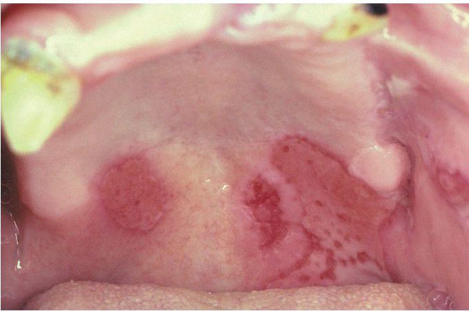 Bullous Pemphigoid.