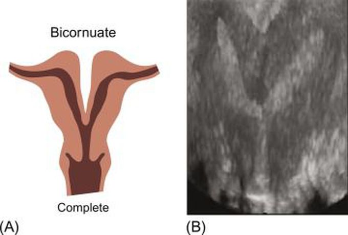 How do you fix a bicornuate uterus?