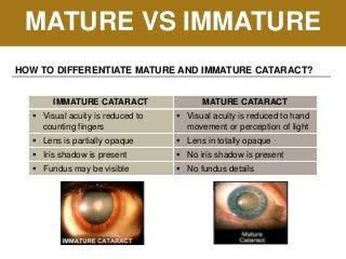 Mature Vs Immature Cataract MEDizzy