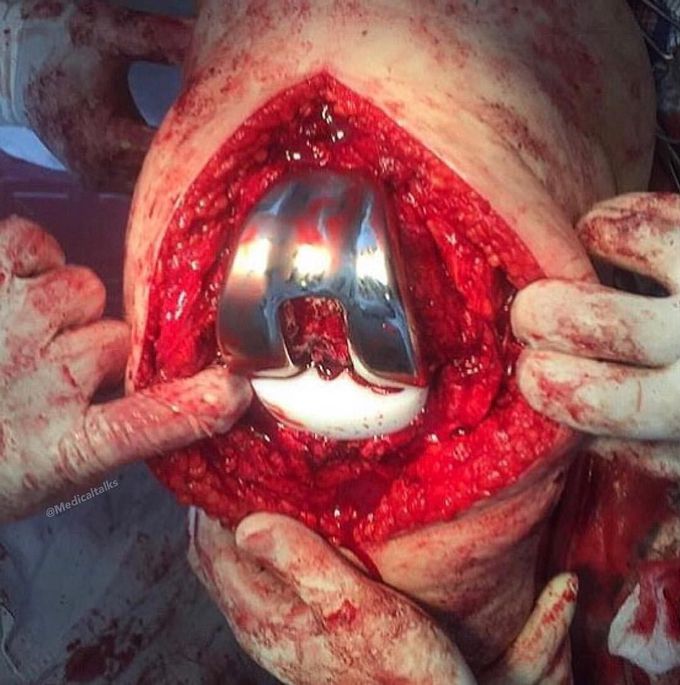 Iron knee!  