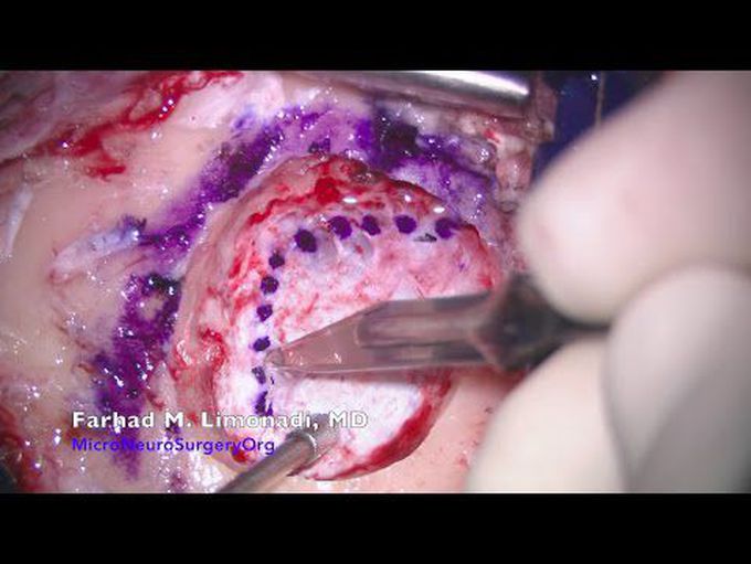Trigeminal Neuralgia Surgery : Video clip of Trigeminal Neuralgia Surgery (MVD)