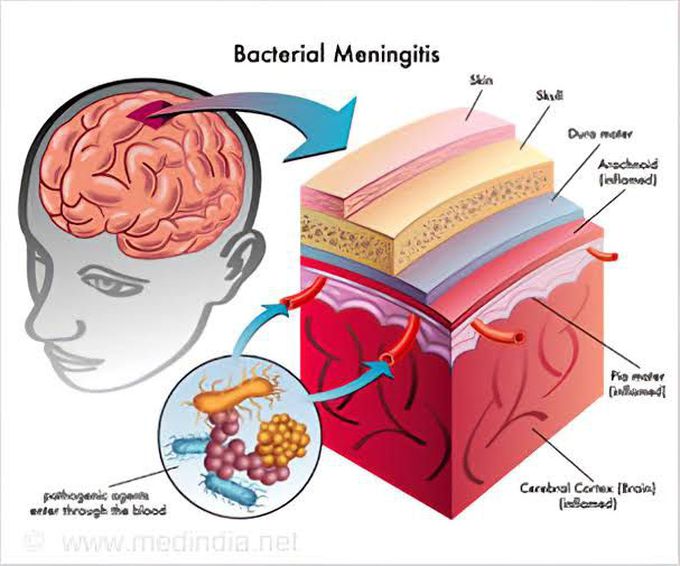 Pyogenic Meningitis