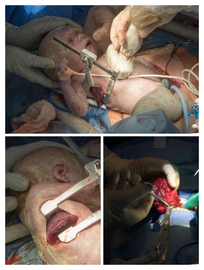 Ex-utero intrapartum treatment (EXIT)