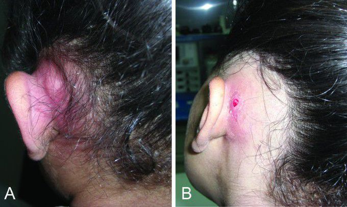 Management of Acute Mastoiditis in Pediatric Age Group