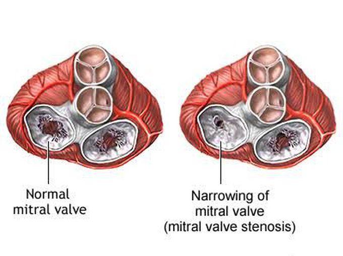 Mitral stenosis