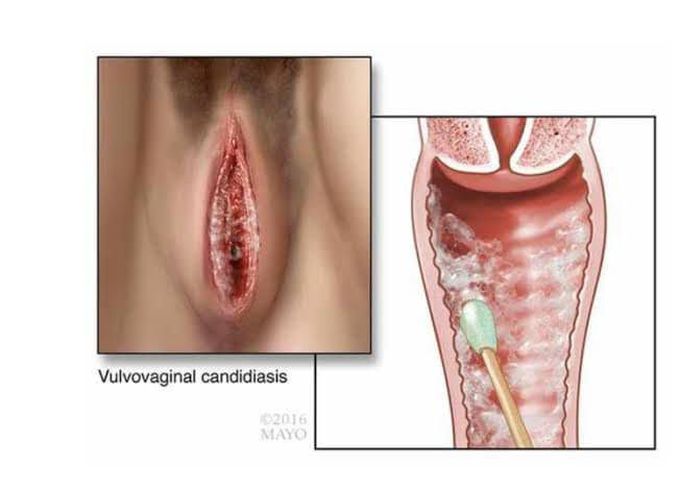 Genital candidiasis