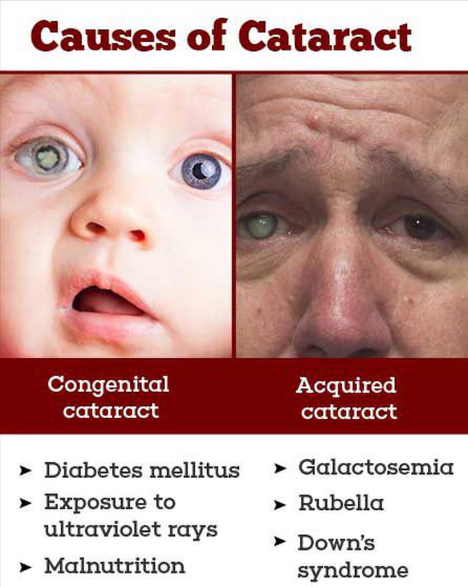 Causes of Cataract