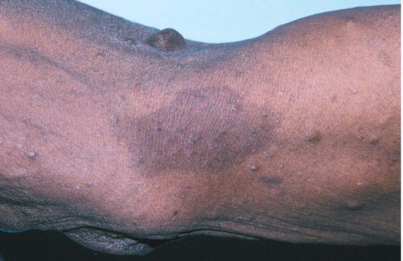 melanotic sarcoma Eye With by Wellcome Images Melanocytic nevi and melanoma: unraveling