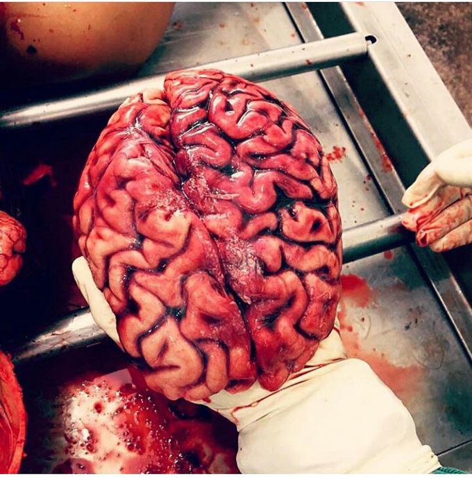 View of brain