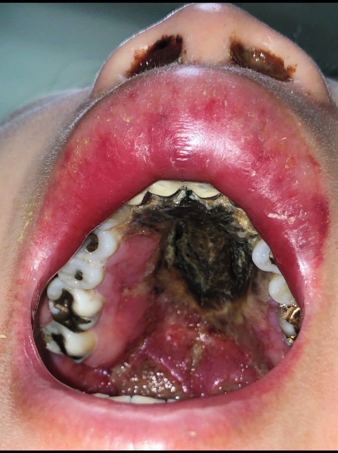 Palatal Ulceration