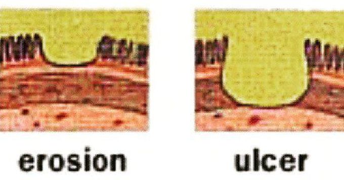 Erosion Vs Ulcer