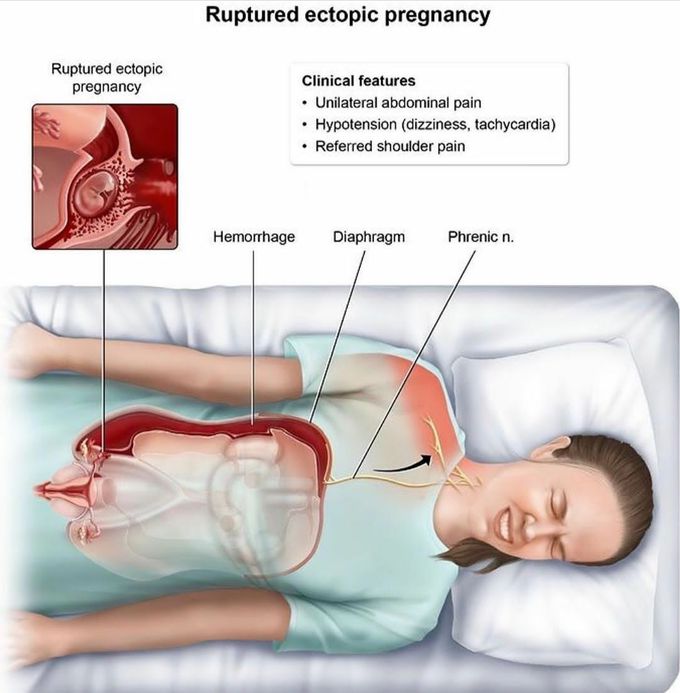 Ruptured  ectopic pregnancy