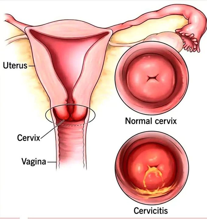 Cervicitis