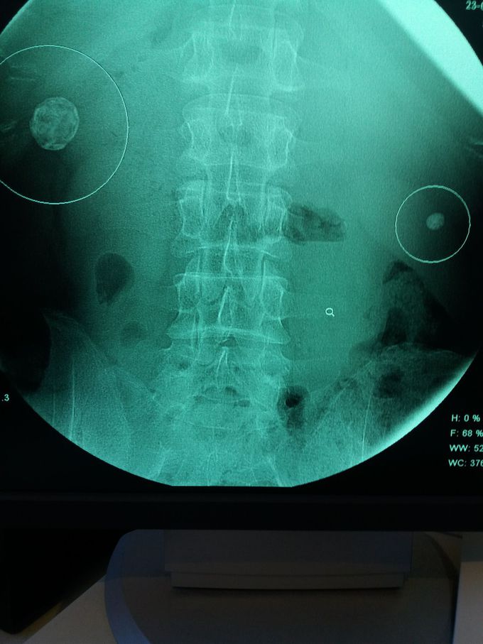 Gall stones and right kidney stoune