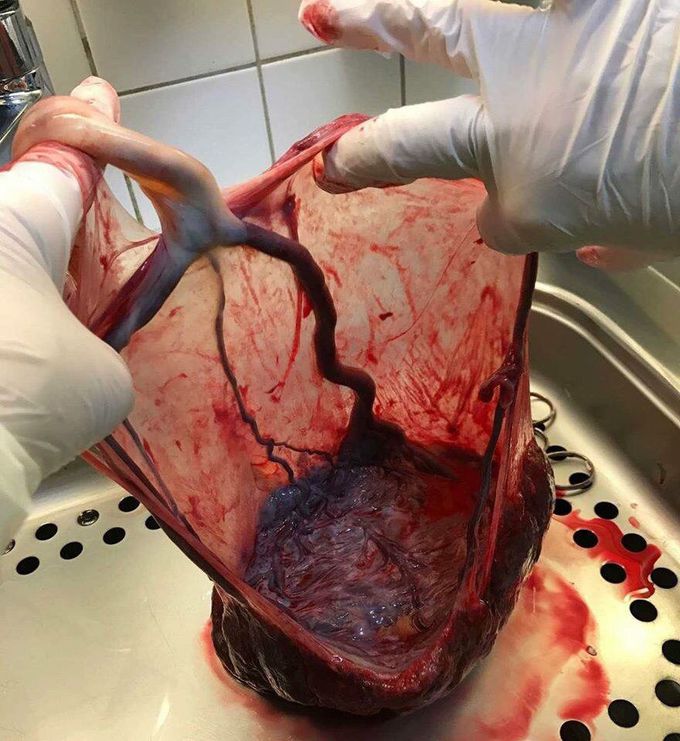 Placenta and umbilical cord