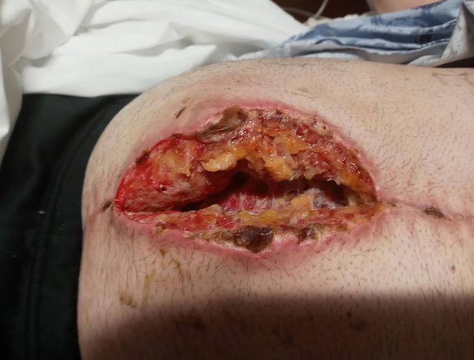 Wound dehiscence after hernia repair!