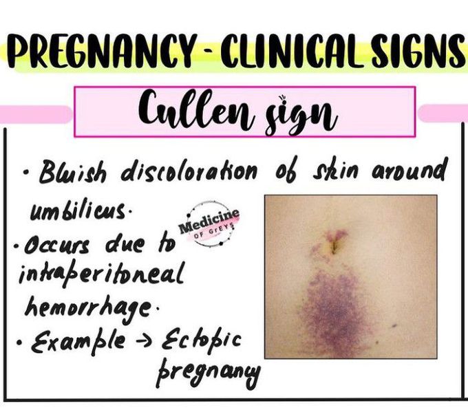 Cullen Sign in Pregnancy