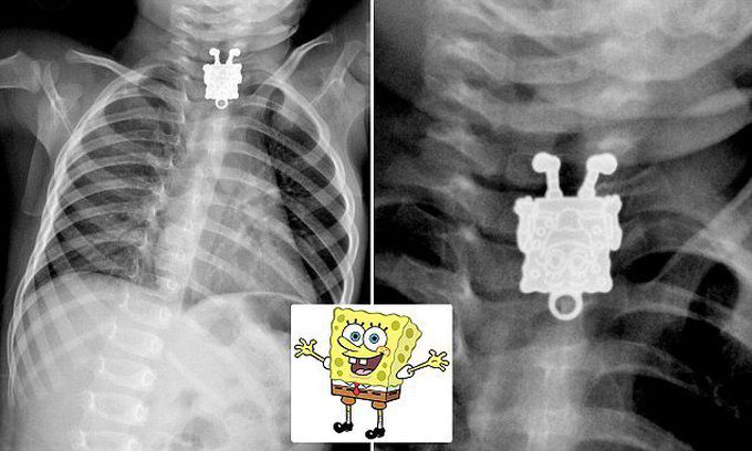 SpongeBob SquarePants in a child's x-ray