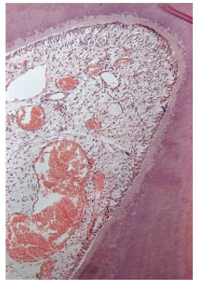 Pulpal hyperaemia.