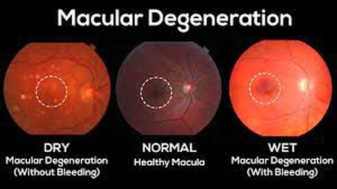 Macular Degeneration: Stem Cells Restore Sight in Small Study

Peter Russell

March 21, 2018