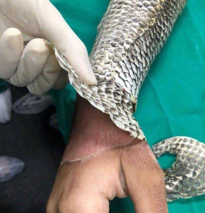 Fish Skin on Arm