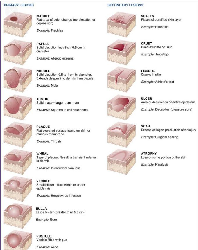 Primary and secondary lesions.