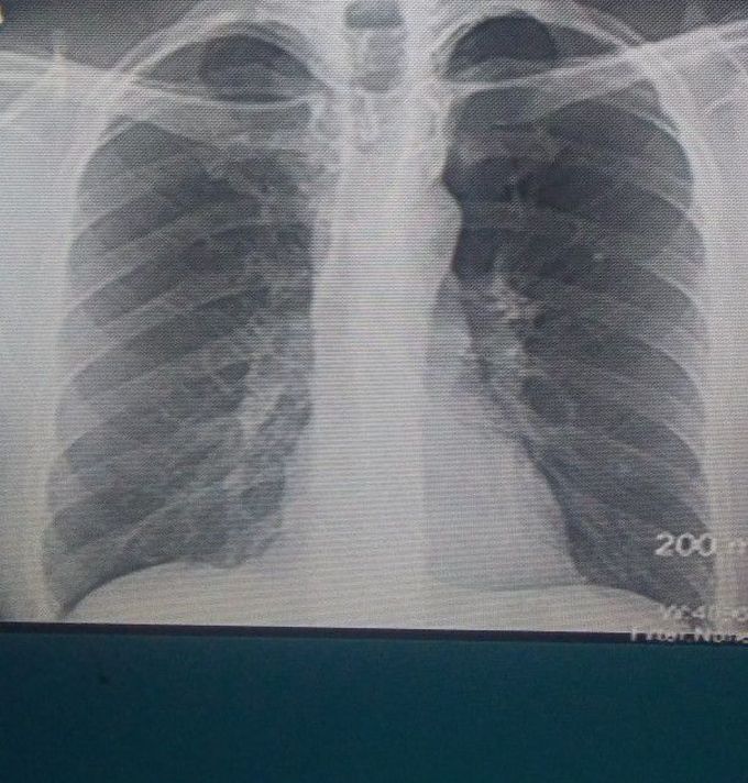 ECG to CXR